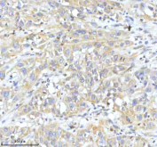 IHC staining of FFPE human pancreas ductal adenocarcinoma tissue with HDHD2 antibody. HIER: boil tissue sections in pH8 EDTA for 20 min and allow to cool before testing.
