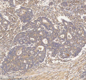 IHC staining of FFPE human colon adenocarcinoma tissue with HDHD2 antibody. HIER: boil tissue sections in pH8 EDTA for 20 min and allow to cool before testing.