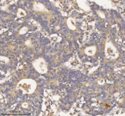 IHC staining of FFPE human colon adenocarcinoma tissue with HDHD2 antibody. HIER: boil tissue sections in pH8 EDTA for 20 min and allow to cool before testing.
