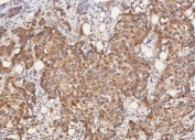 IHC staining of FFPE human breast cancer tissue with STIM1 antibody. HIER: boil tissue sections in pH8 EDTA for 20 min and allow to cool before testing.