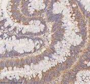IHC staining of FFPE human colon adenocarcinoma tissue with STIM1 antibody. HIER: boil tissue sections in pH8 EDTA for 20 min and allow to cool before testing.