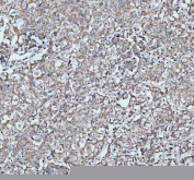 IHC staining of FFPE human parotid acinar cell carcinoma tissue with ARHGEF12 antibody, HRP-labeled secondary and DAB substrate. HIER: boil tissue sections in pH8 EDTA for 20 min and allow to cool before testing.
