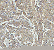 IHC staining of FFPE human squamous cell carcinoma of cervix with ARHGEF12 antibody, HRP-labeled secondary and DAB substrate. HIER: boil tissue sections in pH8 EDTA for 20 min and allow to cool before testing.