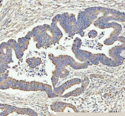 IHC staining of FFPE human colorectal adenocarcinoma tissue with ARHGEF12 antibody, HRP-labeled secondary and DAB substrate. HIER: boil tissue sections in pH8 EDTA for 20 min and allow to cool before testing.