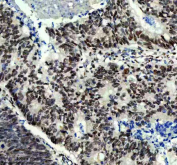 IHC staining of FFPE human colon cancer tissue with Prospero homeobox protein 1 antibody, HRP-secondary and DAB substrate. HIER: boil tissue sections in pH8 EDTA for 20 min and allow to cool before testing.