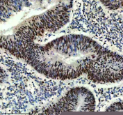 IHC staining of FFPE human colon cancer tissue with Prospero homeobox protein 1 antibody, HRP-secondary and DAB substrate. HIER: boil tissue sections in pH8 EDTA for 20 min and allow to cool before testing.
