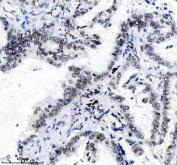 TARDBP Antibody Lung Cancer IHC. Immunohistochemistry analysis of FFPE human lung cancer tissue stained with anti-TARDBP antibody. Following heat-induced epitope retrieval in pH 8 EDTA buffer, strong HRP-DAB brown nuclear staining is observed in malignant epithelial cells, consistent with expression of TAR DNA-binding protein 43 / TDP-43, an RNA-binding protein involved in RNA splicing, mRNA transport, and stress-responsive RNA regulatory pathways.
