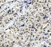 TARDBP Antibody Esophageal Cancer IHC. Immunohistochemistry analysis of FFPE human esophageal cancer tissue stained with anti-TARDBP antibody. Following heat-induced epitope retrieval in pH 8 EDTA buffer, diffuse HRP-DAB brown nuclear staining is observed throughout malignant cell populations, consistent with the known nuclear-associated expression of TAR DNA-binding protein 43 / TDP-43, an RNA-binding protein involved in RNA splicing, stress granule regulation, and post-transcriptional RNA metabolism.