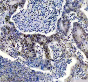 TARDBP Antibody Rectal Cancer IHC. Immunohistochemistry analysis of FFPE human rectal cancer tissue stained with anti-TARDBP antibody. Following heat-induced epitope retrieval in pH 8 EDTA buffer, moderate to strong HRP-DAB brown nuclear staining is observed in malignant glandular epithelial cells, consistent with expression of TAR DNA-binding protein 43 / TDP-43, an RNA-binding protein involved in RNA processing, mRNA stability, and stress-responsive post-transcriptional regulatory pathways.