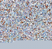 IHC staining of FFPE human stomach cancer tissue with ME1 antibody, HRP-secondary and DAB substrate. HIER: boil tissue sections in pH8 EDTA for 20 min and allow to cool before testing.