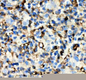 IHC staining of FFPE human glioma tissue with Alpha-Synuclein antibody, HRP-secondary and DAB substrate. HIER: boil tissue sections in pH8 EDTA for 20 min and allow to cool before testing.