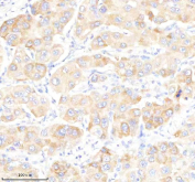 IHC staining of FFPE human liver cancer tissue with GABARAPL2 antibody, HRP-secondary and DAB substrate. HIER: boil tissue sections in pH8 EDTA for 20 min and allow to cool before testing.