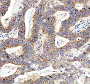 IHC staining of FFPE human stomach cancer tissue with MYO7A antibody, HRP-secondary and DAB substrate. HIER: boil tissue sections in pH8 EDTA for 20 min and allow to cool before testing.