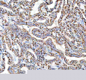 IHC staining of FFPE human thyroid cancer tissue with PDC-E2 antibody, HRP-secondary and DAB substrate. HIER: boil tissue sections in pH8 EDTA for 20 min and allow to cool before testing.
