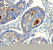 IHC staining of FFPE human colon cancer tissue with CHMP2B antibody, HRP-secondary and DAB substrate. HIER: boil tissue sections in pH8 EDTA for 20 min and allow to cool before testing.