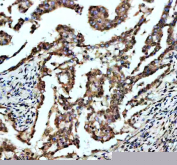 IHC staining of FFPE human lung cancer tissue with FOXF1 antibody, HRP-secondary and DAB substrate. HIER: boil tissue sections in pH8 EDTA for 20 min and allow to cool before testing.