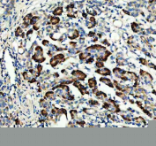 IHC staining of FFPE human pancreas cancer tissue with RAPGEF4 antibody, HRP-secondary and DAB substrate. HIER: boil tissue sections in pH8 EDTA for 20 min and allow to cool before testing.