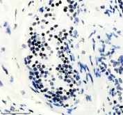 IHC staining of FFPE human prostate cancer tissue with PHF8 antibody, HRP-secondary and DAB substrate. HIER: boil tissue sections in pH8 EDTA for 20 min and allow to cool before testing.