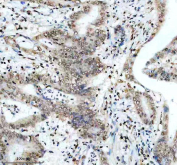 IHC staining of FFPE human colon cancer tissue with PHF8 antibody, HRP-secondary and DAB substrate. HIER: boil tissue sections in pH8 EDTA for 20 min and allow to cool before testing.