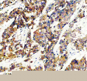 IHC staining of FFPE human colon cancer tissue with GLB1 antibody, HRP-secondary and DAB substrate. HIER: boil tissue sections in pH8 EDTA for 20 min and allow to cool before testing.