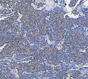 IHC staining of FFPE human skin cancer tissue with DEAD box protein 1 antibody, HRP-secondary and DAB substrate. HIER: boil tissue sections in pH8 EDTA for 20 min and allow to cool before testing.