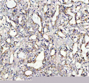 IHC staining of FFPE human prostatic acinar adenocarcinoma tissue with SOCS5 antibody, HRP-secondary and DAB substrate. HIER: boil tissue sections in pH8 EDTA for 20 min and allow to cool before testing.