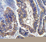 IHC staining of FFPE human colon cancer tissue with NDUFS1 antibody, HRP-secondary and DAB substrate. HIER: boil tissue sections in pH8 EDTA for 20 min and allow to cool before testing.