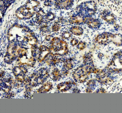 IHC staining of FFPE human breast cancer tissue with STXBP4 antibody, HRP-secondary and DAB substrate. HIER: boil tissue sections in pH8 EDTA for 20 min and allow to cool before testing.