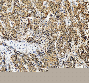 IHC staining of FFPE human liver cancer tissue with PSMA5 antibody, HRP-secondary and DAB substrate. HIER: boil tissue sections in pH8 EDTA for 20 min and allow to cool before testing.