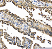 IHC staining of FFPE human ovarian cancer tissue with PSMC1 antibody, HRP-secondary and DAB substrate. HIER: boil tissue sections in pH8 EDTA for 20 min and allow to cool before testing.