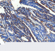 IHC staining of FFPE human colon cancer tissue with CPT2 antibody, HRP-secondary and DAB substrate. HIER: boil tissue sections in pH8 EDTA for 20 min and allow to cool before testing.