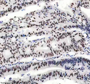 IHC staining of FFPE human colon cancer tissue with PABPN1 antibody, HRP-secondary and DAB substrate. HIER: boil tissue sections in pH8 EDTA for 20 min and allow to cool before testing.