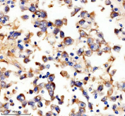 IHC staining of FFPE human testis cancer tissue with UPF1 antibody, HRP-secondary and DAB substrate. HIER: boil tissue sections in pH8 EDTA for 20 min and allow to cool before testing.