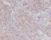 IHC staining of FFPE human breast carcinoma tissue with Alpha Actin antibody, HRP-secondary and DAB substrate. HIER: boil tissue sections in pH8 EDTA for 20 min and allow to cool before testing.