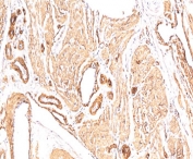 IHC: FFPE human leiomyosarcoma stained with Smooth Muscle Actin antibody (clone 1A4).