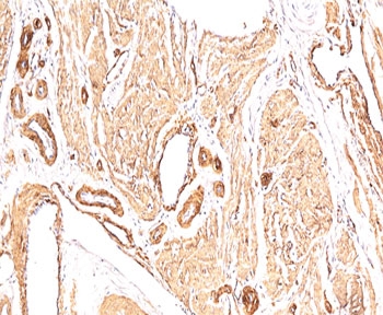 IHC: FFPE human leiomyosarcoma stained with Smooth Muscle Actin antibody (clone 1A4).~