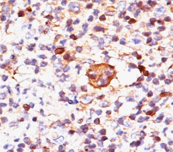 IHC testing of FFPE Hodgkin's lymphoma stained with Bax antibody (clone 2D2).~