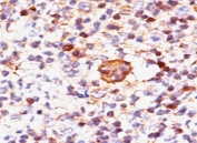 IHC testing of FFPE Hodgkin's lymphoma stained with Bax antibody (clone 2D2).