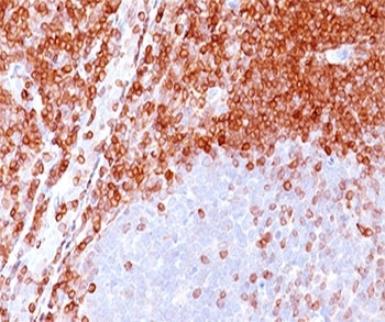 IHC testing of formalin-paraffin non-Hodgkin's lymphoma stained with Bcl-2 antibody (100/D5). Note nuclear membrane & cytoplasmic staining.~