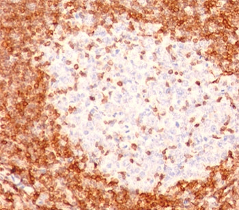 IHC testing of human tonsil stained with Bcl-2 antibody (8C8).Note cell membrane and cytoplasmic staining.~