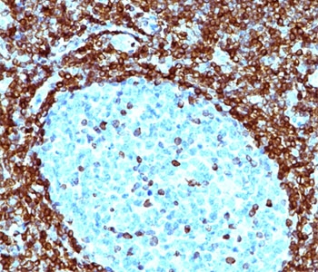 IHC testing of human non-Hodgkin's lymphoma stained with Bcl-2 antibody (124). Note nuclear membrane & cytoplasmic staining.~