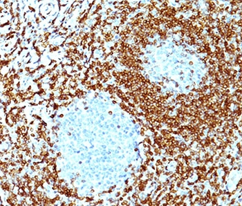 FFPE non-Hodgkin's lymphoma stained with Bcl2 antibody cocktail.