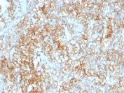 IHC testing of FFPE human renal cell carcinoma with CD147 antibody (clone 8D6).