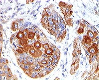 IHC testing of FFPE human esophageal tumor stained with CD86 antibody (clone BU63).~