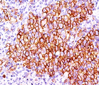 IHC testing of Hodgkin's lymphoma (20X) stained with CD30 antibody (CD30/412).~