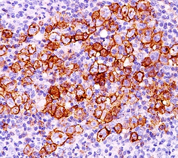 IHC testing of Hodgkin's lymphoma (20X) stained with CD30 antibody (CD30/412).