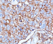 IHC testing of FFPE human breast cancer stained with HCAM antibody (clone 156-3C11).