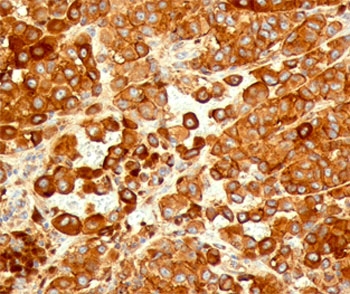 IHC testing of human melanoma stained with CD63 antibody (NKI/C3).~