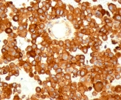 IHC testing of FFPE human melanoma stained with CD63 antibody (clone MX49.129.5).
