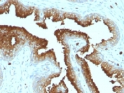 IHC testing of FFPE prostate carcinoma with CD63 antibody (clone MX-49.129.5).